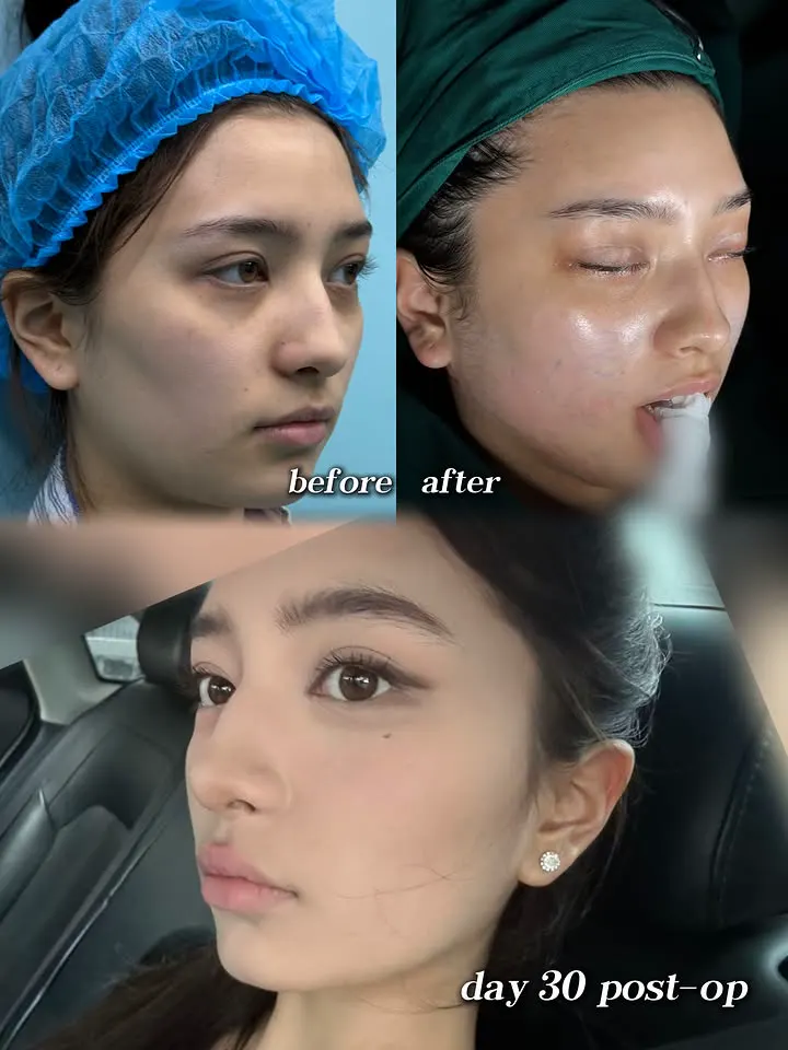 Russia patient preoperative, immediate postoperative and day-30 recovery story