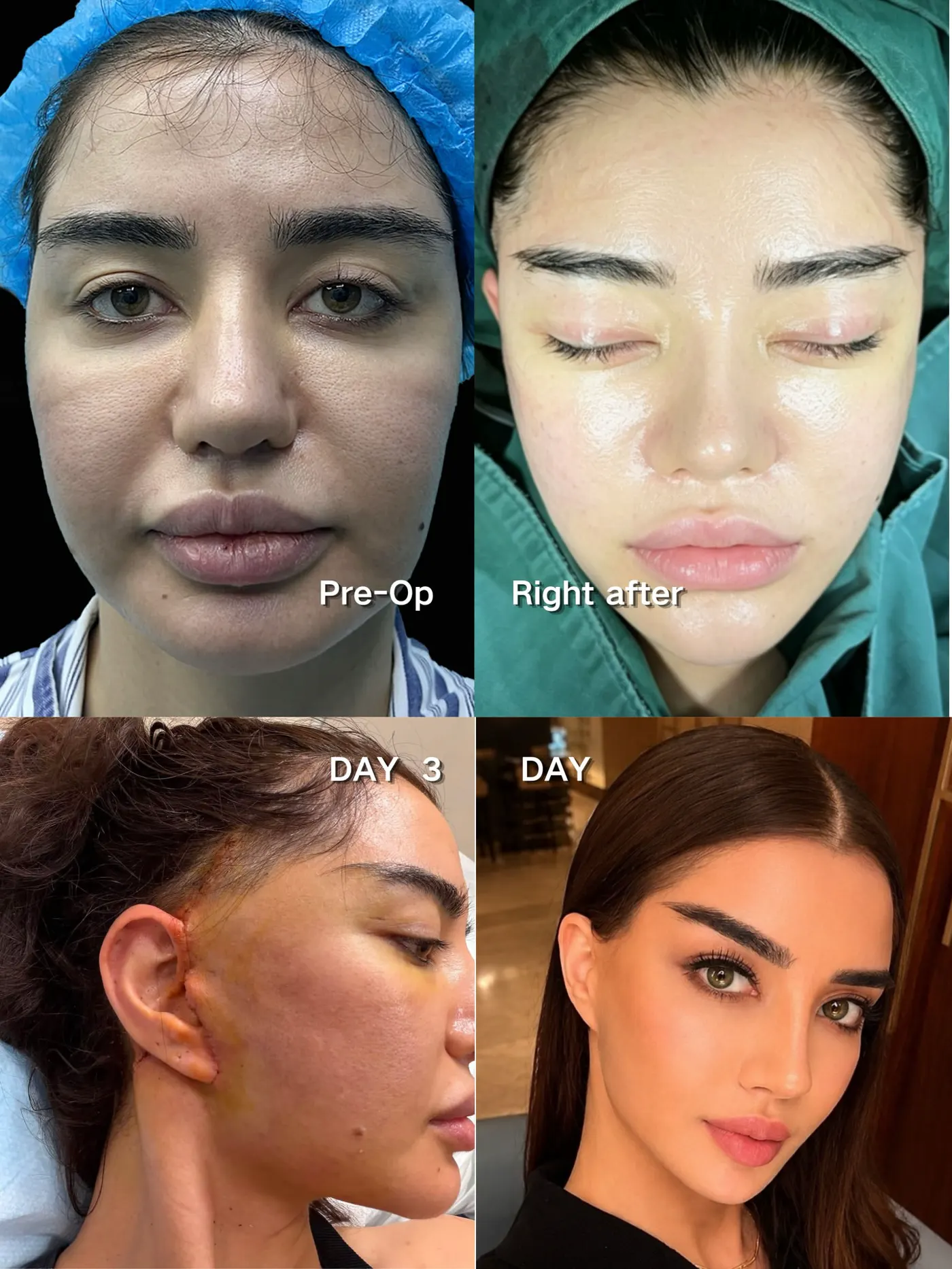 Türkiye patient preoperative, immediate postoperative, day-three and later recovery sequence
